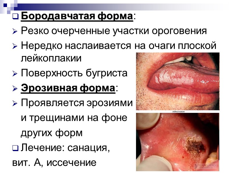 Бородавчатая форма: Резко очерченные участки ороговения Нередко наслаивается на очаги плоской лейкоплакии Поверхность бугриста